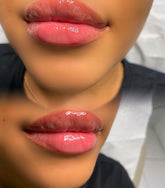 Lip Fillers