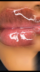 Lip Fillers