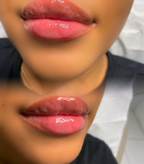 Lip Fillers